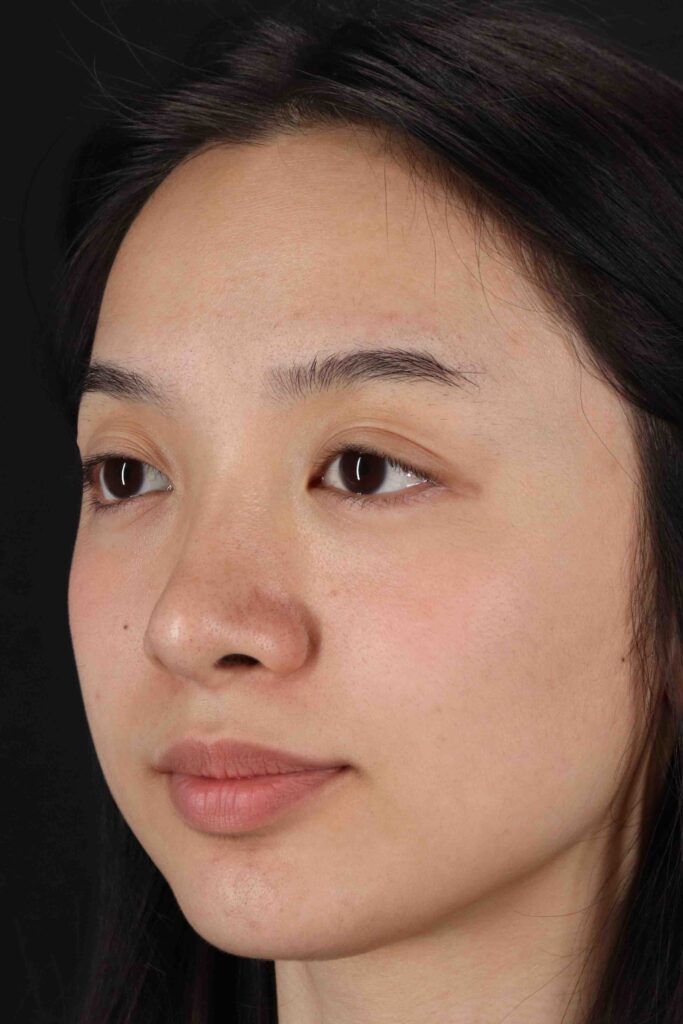 After - left_oblique