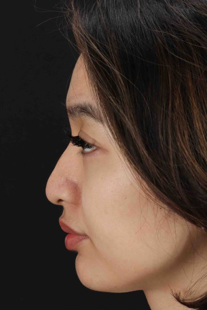 Before - left_lateral