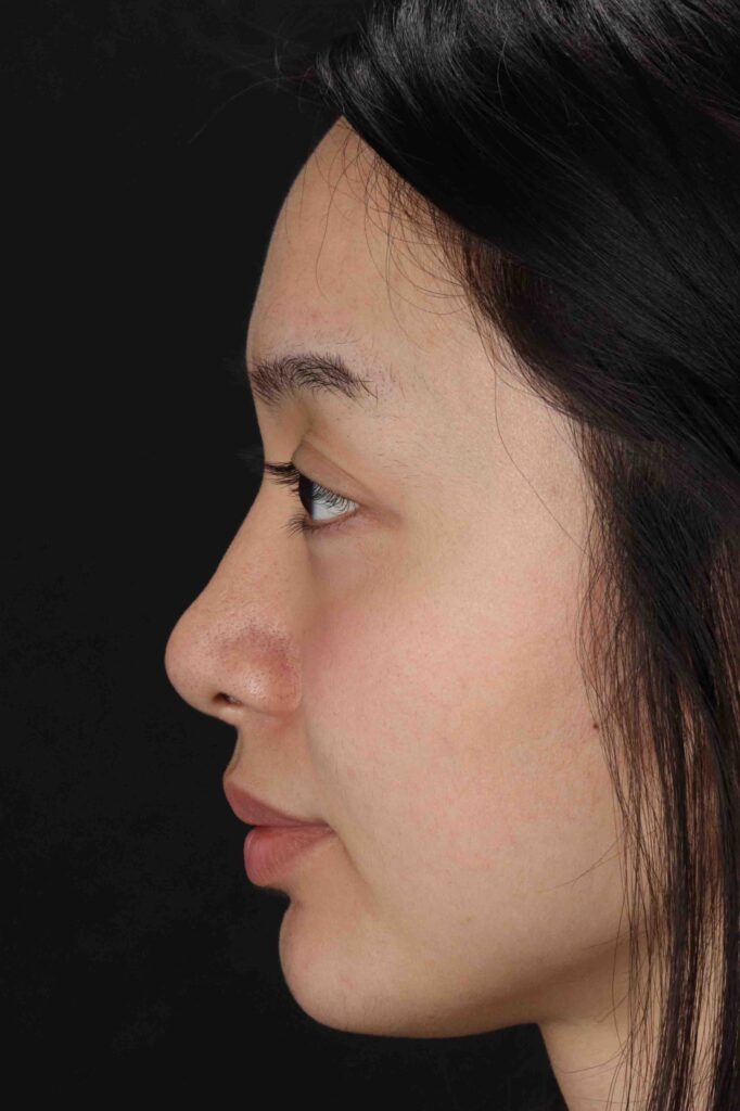 After - left_lateral