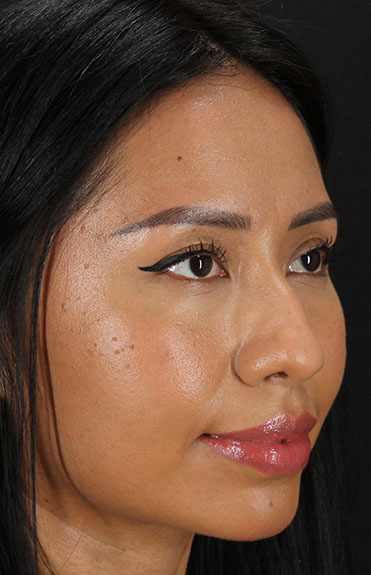 Before - right_oblique