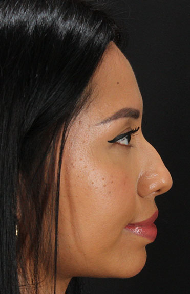 Before - right_lateral