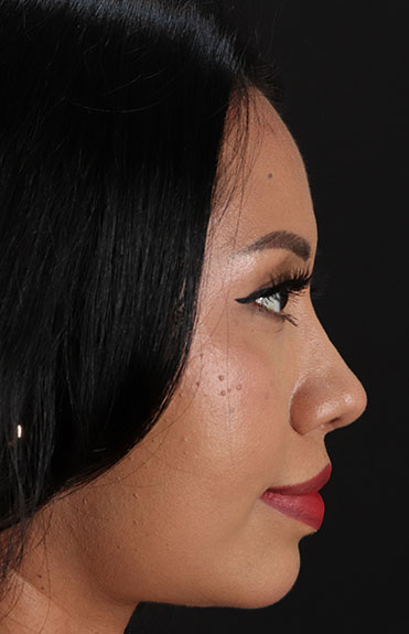 After - right_lateral