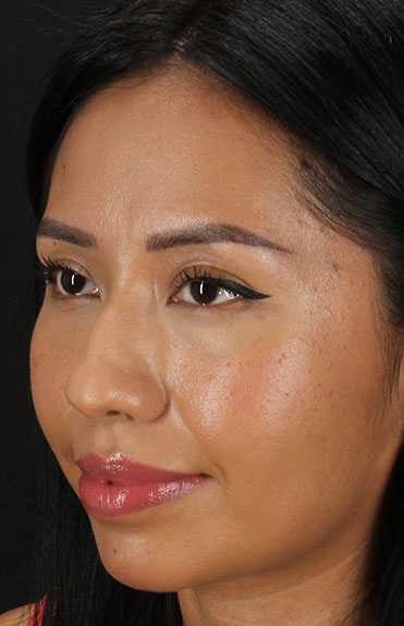 Before - left_oblique