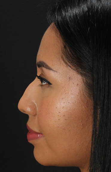 Before - left_lateral