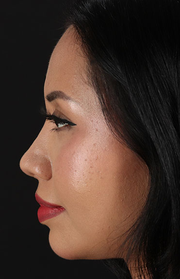 After - left_lateral