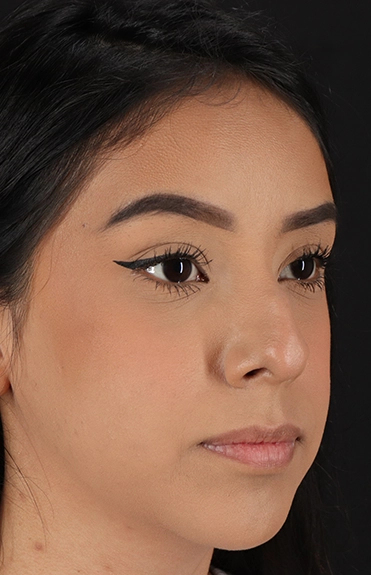 Before - right_oblique