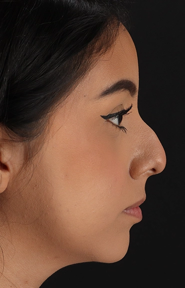 Before - right_lateral