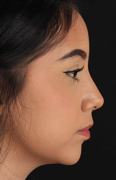 After - right_lateral