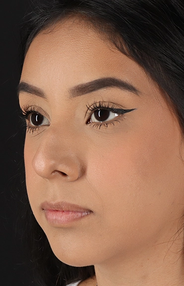 Before - left_oblique