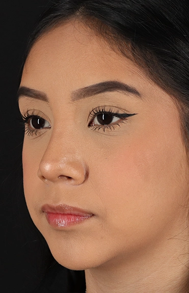 After - left_oblique