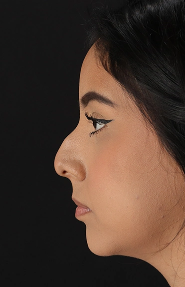 Before - left_lateral