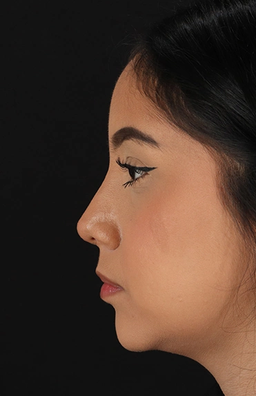 After - left_lateral