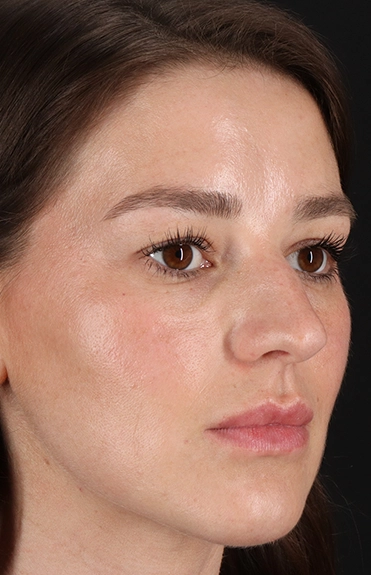 Before - right_oblique