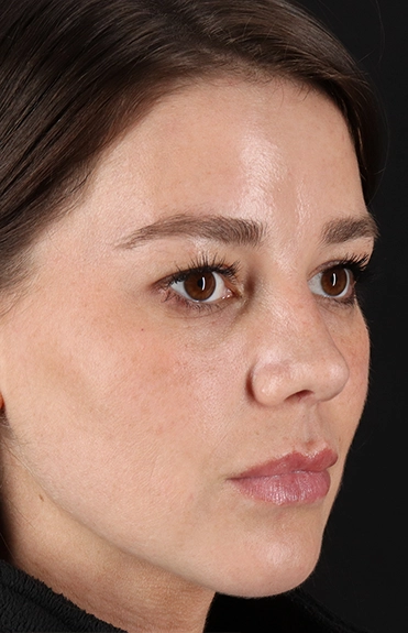 After - right_oblique