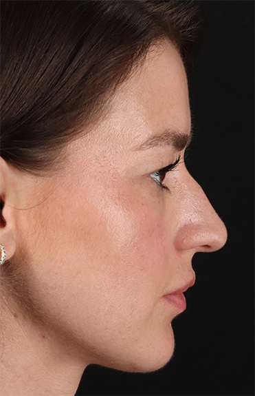 Before - right_lateral