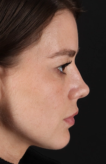 After - right_lateral