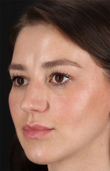 Before - left_oblique