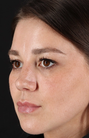 After - left_oblique