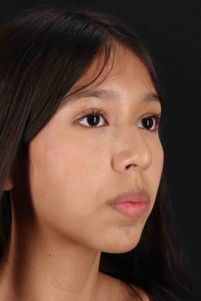 Before - right_oblique