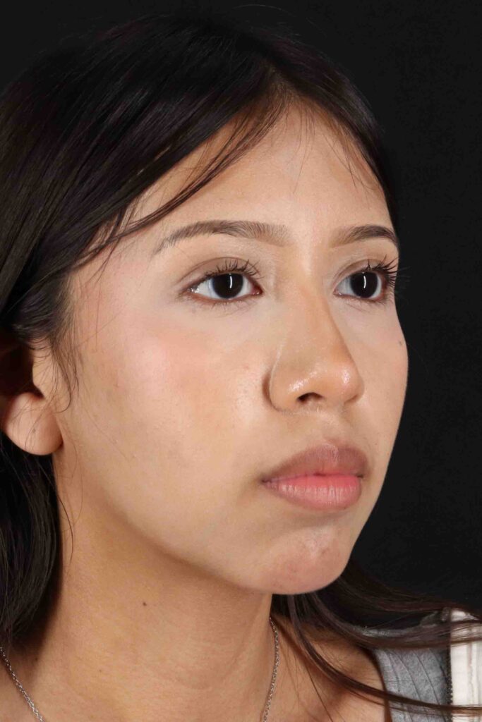 After - right_oblique