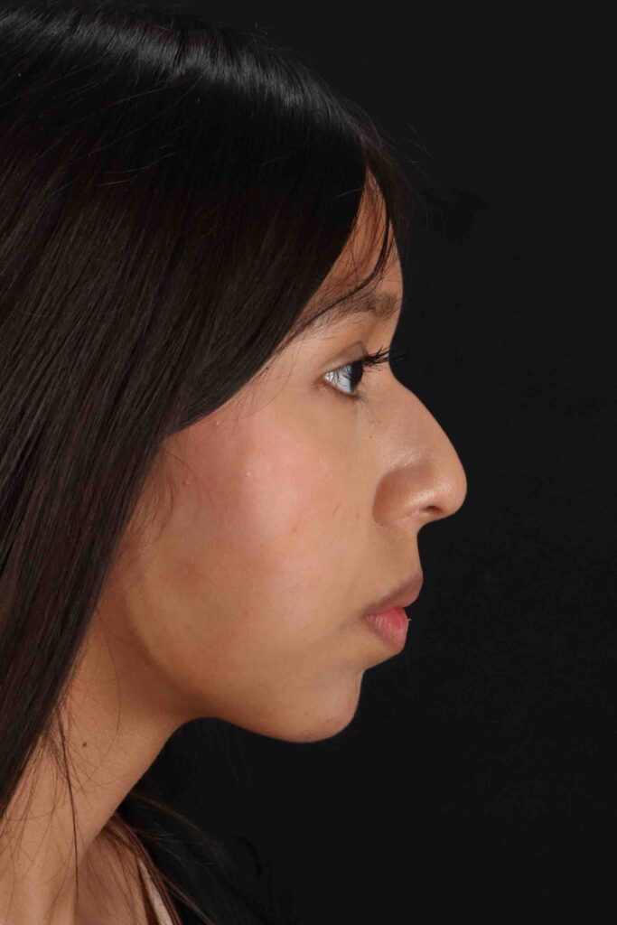 Before - right_lateral