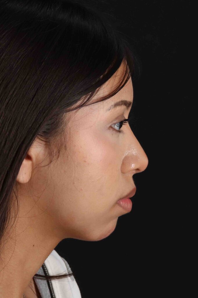 After - right_lateral