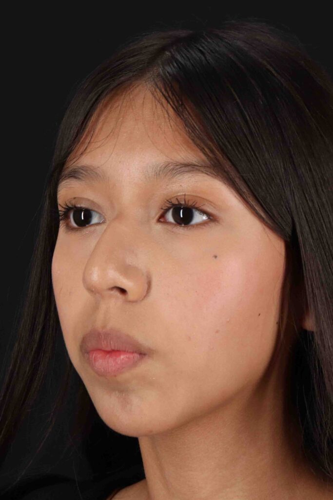 Before - left_oblique