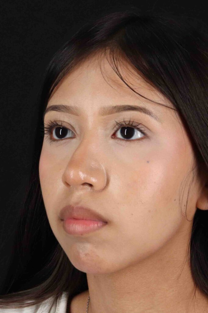 After - left_oblique