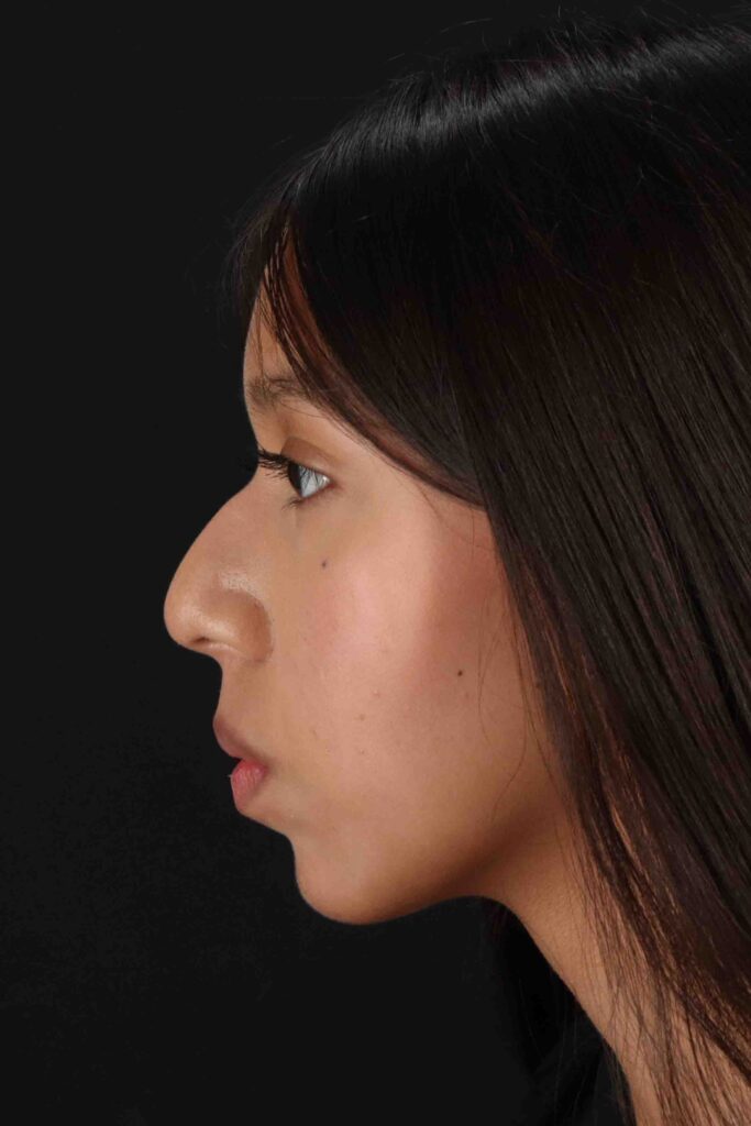 Before - left_lateral