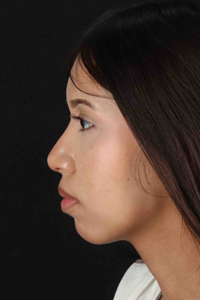 After - left_lateral