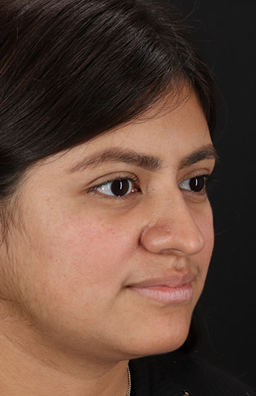 Before - right_oblique