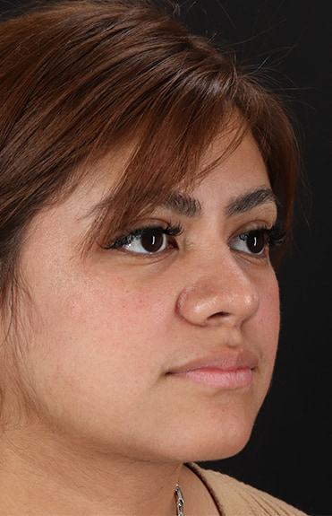 After - right_oblique