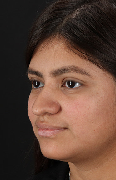 Before - left_oblique