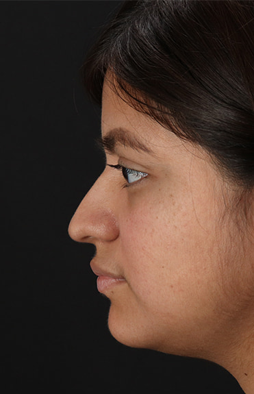 Before - left_lateral