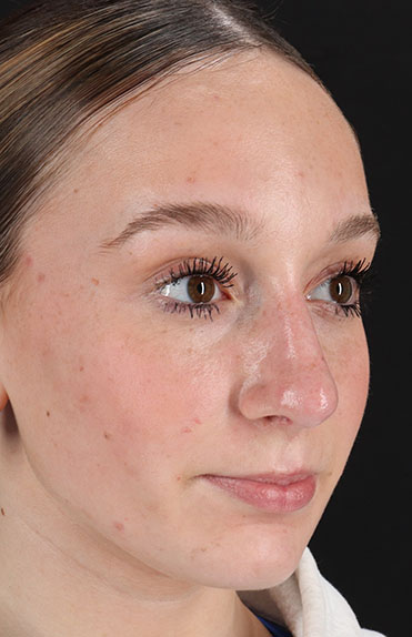 After - right_oblique