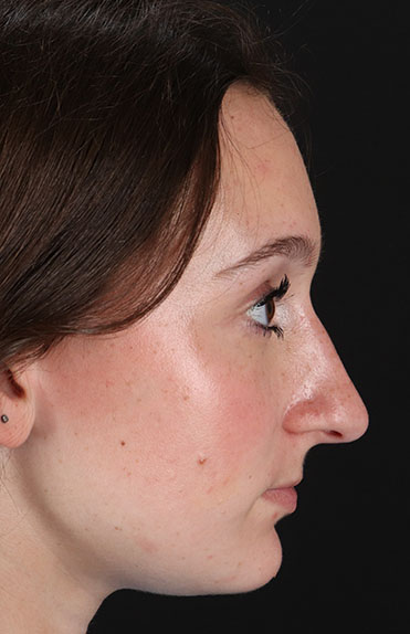 Before - right_lateral