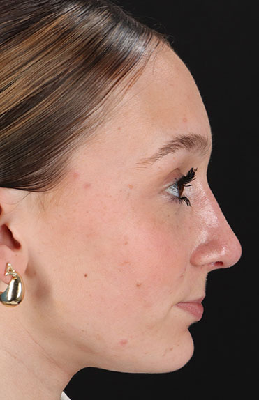 After - right_lateral