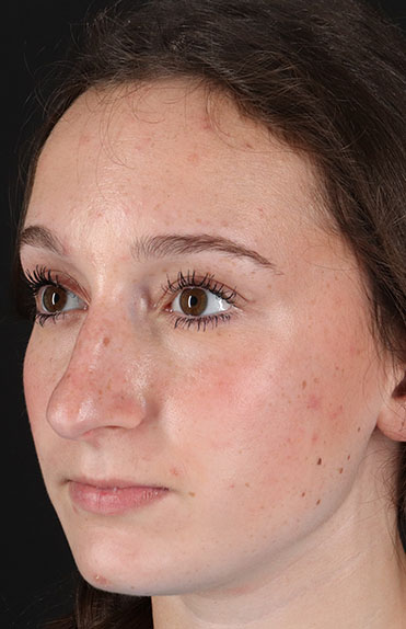 Before - left_oblique