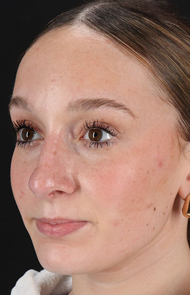 After - left_oblique