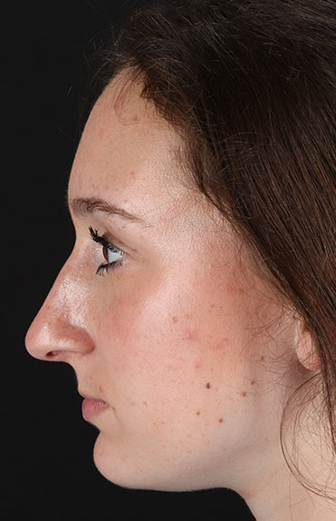 Before - left_lateral