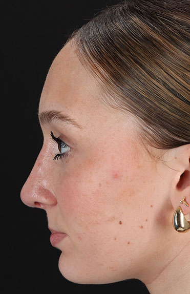 After - left_lateral