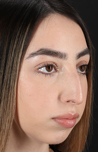 Before - right_oblique