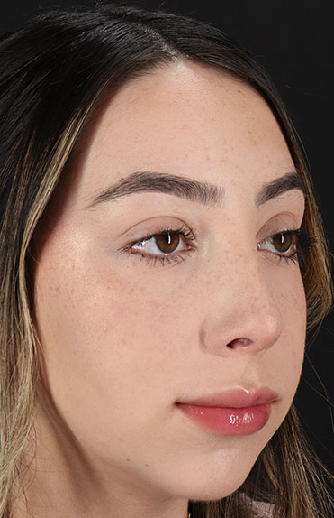 After - right_oblique