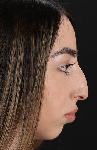 Before - right_lateral