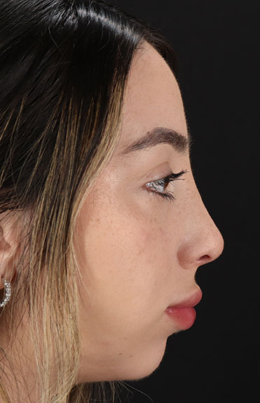 After - right_lateral