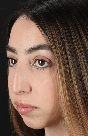 Before - left_oblique