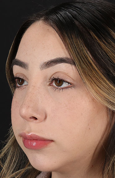 After - left_oblique