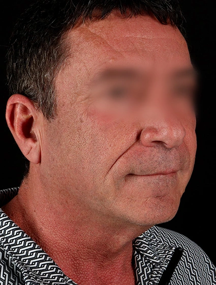 Before - right_oblique