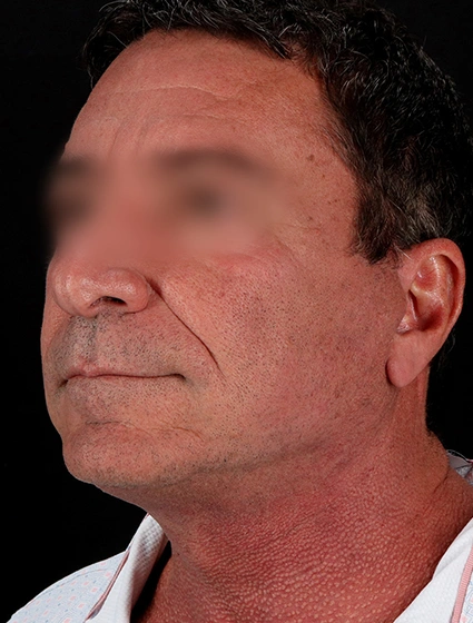 After - left_oblique