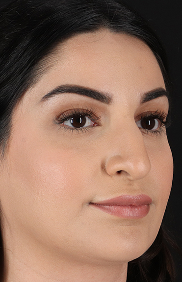 Before - right_oblique